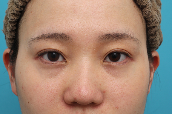 目尻切開,垂れ目形成、目尻切開の症例写真,After（6ヶ月後）,ba_panda022_b01.jpg