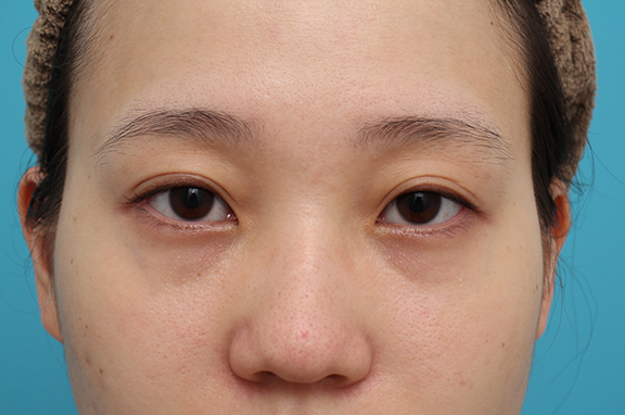 垂れ目（パンダ目）形成（グラマラスライン／下眼瞼下制術）,垂れ目形成、目尻切開の症例写真,Before,ba_panda022_b01.jpg