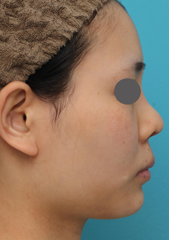 鼻中隔延長（鼻先を大きく下方に延ばす）,鼻中隔延長術（open法）、鼻プロテーゼの症例写真,After（6ヶ月後）,ba_bichukaku004_b01.jpg