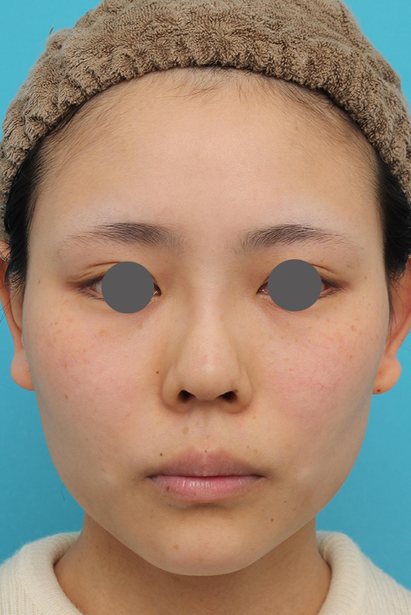 隆鼻術（シリコンプロテーゼ）,鼻中隔延長術（open法）、鼻プロテーゼの症例写真,After（6ヶ月後）,ba_bichukaku004_b02.jpg
