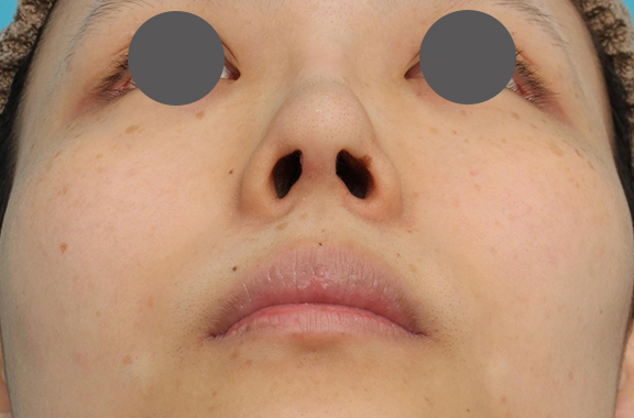鼻中隔延長（鼻先を大きく下方に延ばす）,鼻中隔延長術（open法）、鼻プロテーゼの症例写真,After（6ヶ月後）,ba_bichukaku004_b03.jpg