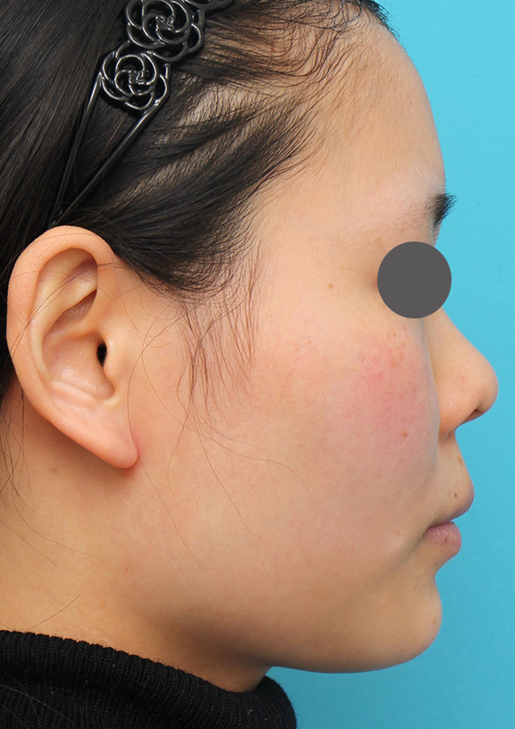 鼻中隔延長（鼻先を大きく下方に延ばす）,鼻中隔延長術（open法）、鼻プロテーゼの症例写真,Before,ba_bichukaku004_b01.jpg