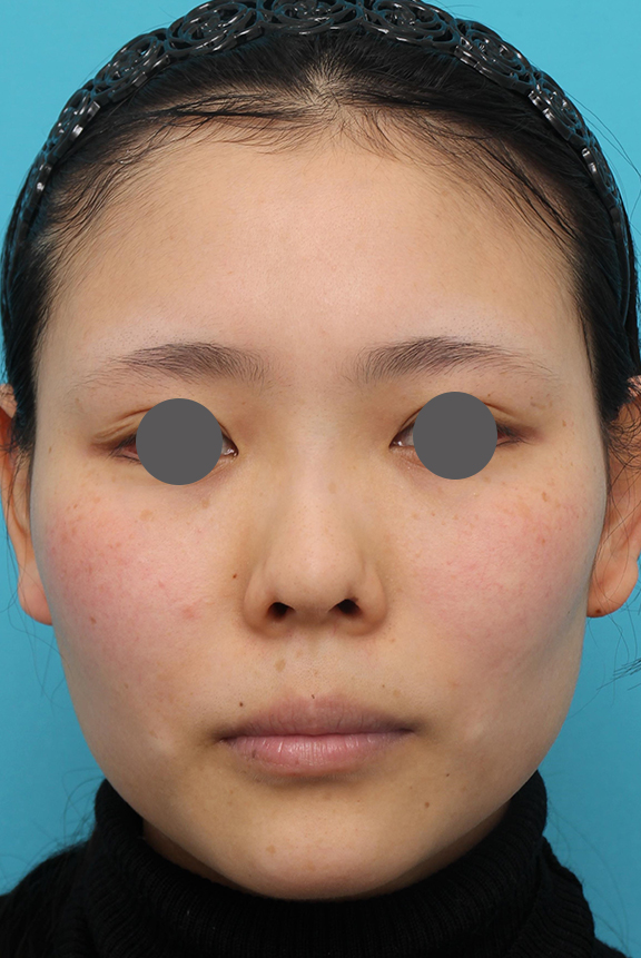 隆鼻術（シリコンプロテーゼ）,鼻中隔延長術（open法）、鼻プロテーゼの症例写真,Before,ba_bichukaku004_b02.jpg
