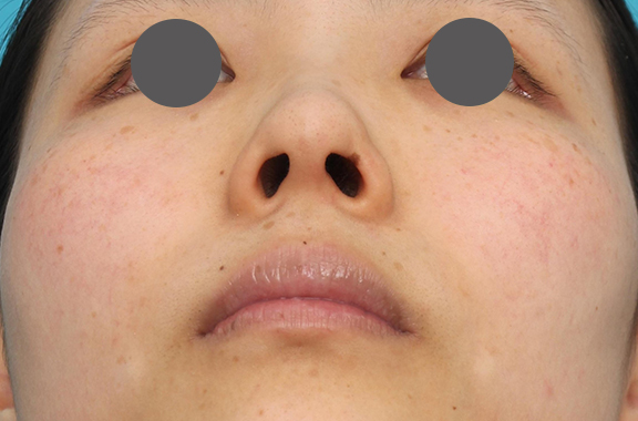 鼻中隔延長（鼻先を大きく下方に延ばす）,鼻中隔延長術（open法）、鼻プロテーゼの症例写真,Before,ba_bichukaku004_b03.jpg