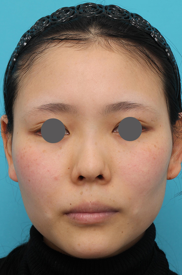 鼻中隔延長（鼻先を大きく下方に延ばす）,鼻中隔延長術（open法）、鼻プロテーゼの症例写真,施術前,mainpic_bichukaku004a.jpg