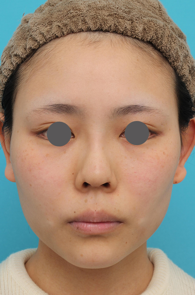 鼻中隔延長（鼻先を大きく下方に延ばす）,鼻中隔延長術（open法）、鼻プロテーゼの症例写真,1ヶ月後,mainpic_bichukaku004b.jpg