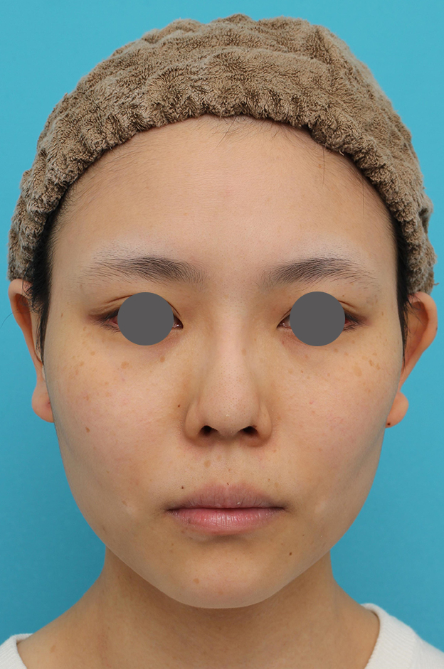隆鼻術（シリコンプロテーゼ）,鼻中隔延長術（open法）、鼻プロテーゼの症例写真,6ヶ月後,mainpic_bichukaku004c.jpg