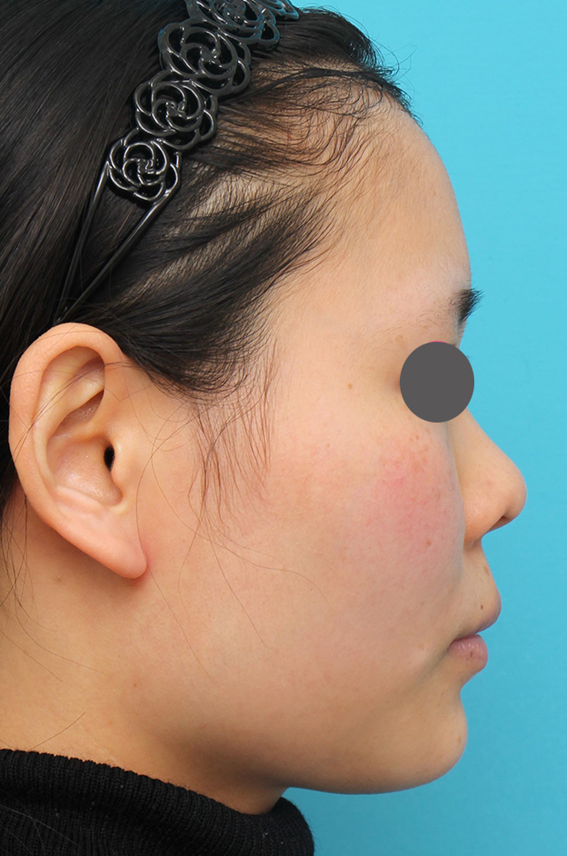 隆鼻術（シリコンプロテーゼ）,鼻中隔延長術（open法）、鼻プロテーゼの症例写真,施術前,mainpic_bichukaku004d.jpg
