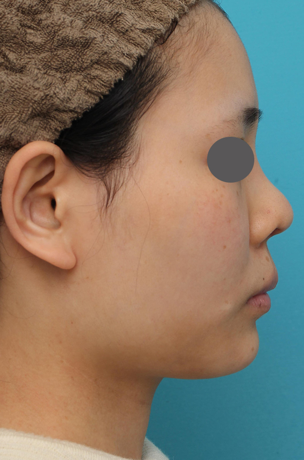 鼻中隔延長（鼻先を大きく下方に延ばす）,鼻中隔延長術（open法）、鼻プロテーゼの症例写真,1ヶ月後,mainpic_bichukaku004e.jpg
