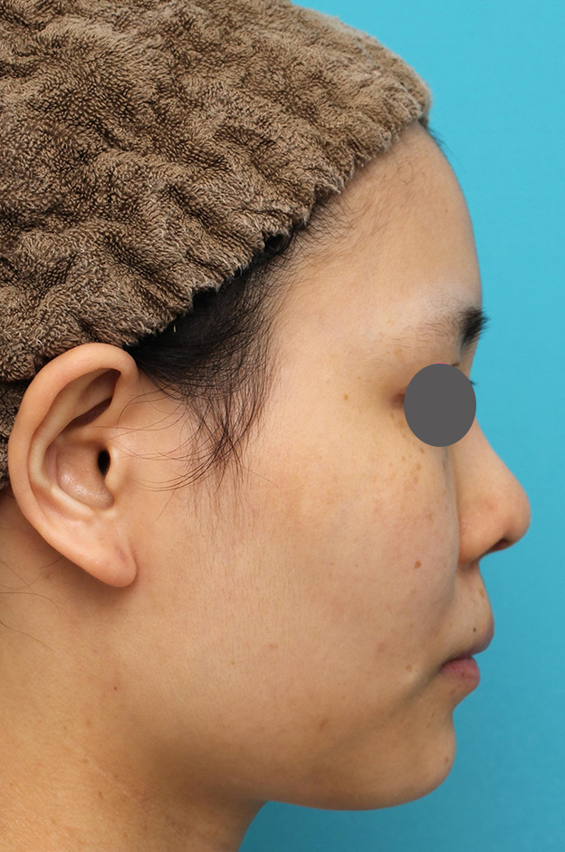 鼻中隔延長（鼻先を大きく下方に延ばす）,鼻中隔延長術（open法）、鼻プロテーゼの症例写真,6ヶ月後,mainpic_bichukaku004f.jpg