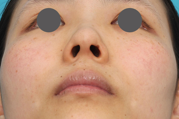 隆鼻術（シリコンプロテーゼ）,鼻中隔延長術（open法）、鼻プロテーゼの症例写真,施術前,mainpic_bichukaku004g.jpg