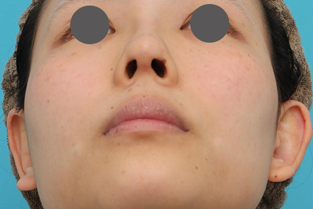 隆鼻術（シリコンプロテーゼ）,鼻中隔延長術（open法）、鼻プロテーゼの症例写真,1ヶ月後,mainpic_bichukaku004h.jpg
