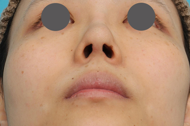 鼻中隔延長（鼻先を大きく下方に延ばす）,鼻中隔延長術（open法）、鼻プロテーゼの症例写真,6ヶ月後,mainpic_bichukaku004i.jpg