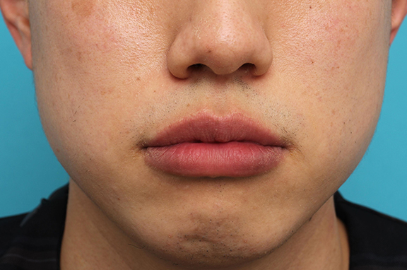鼻翼縮小（小鼻縮小）,上下口唇薄く（口唇縮小術）と鼻翼縮小術の症例写真,After（6ヶ月後）,ba_usuku018_b01.jpg