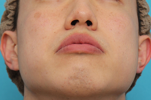 鼻翼縮小（小鼻縮小）,上下口唇薄く（口唇縮小術）と鼻翼縮小術の症例写真,After（6ヶ月後）,