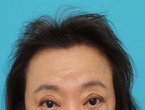 AGA治療（高須式メディカル育毛プログラム）,女性の薄毛治療の症例写真,After（4ヶ月後）,ba_aga_josei005_b01.jpg