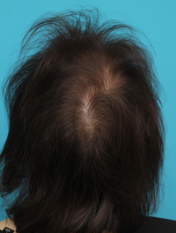 女性の薄毛治療,女性の薄毛治療の症例写真,After（4ヶ月後）,ba_aga_josei005_b02.jpg