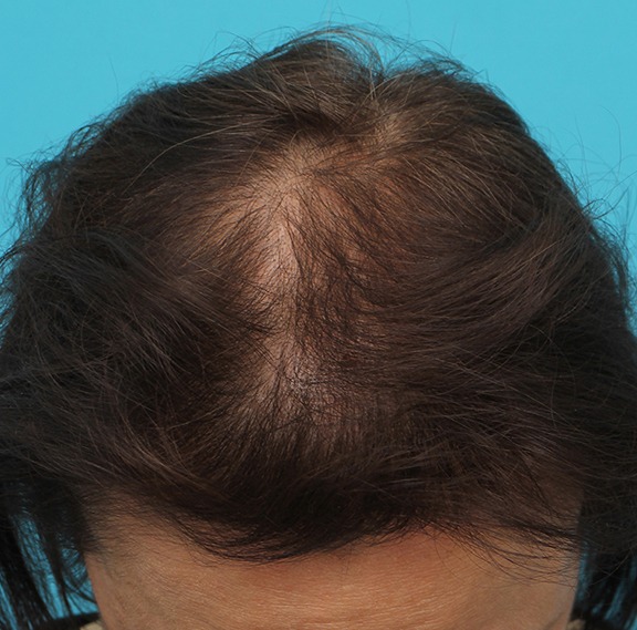 女性の薄毛治療,女性の薄毛治療の症例写真,After（4ヶ月後）,ba_aga_josei005_b03.jpg