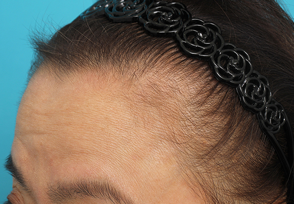 AGA治療（高須式メディカル育毛プログラム）,女性の薄毛治療の症例写真,After（4ヶ月後）,ba_aga_josei005_b04.jpg