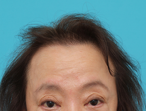 女性の薄毛治療,女性の薄毛治療の症例写真,Before,ba_aga_josei005_b01.jpg