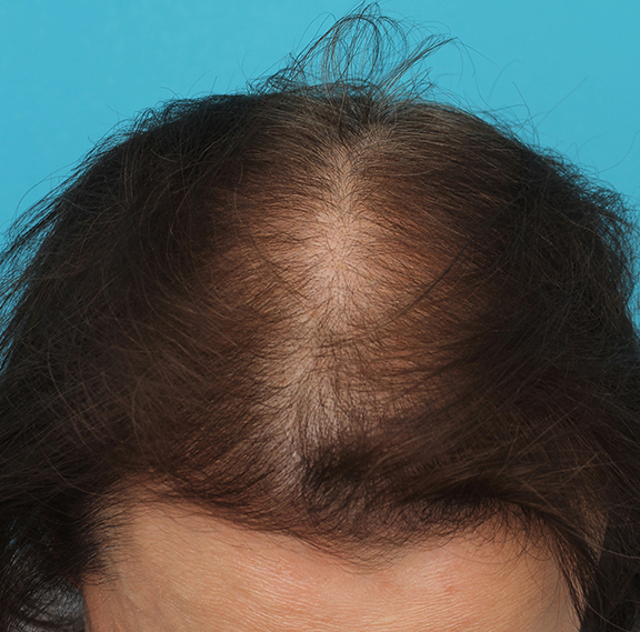 女性の薄毛治療,女性の薄毛治療の症例写真,Before,ba_aga_josei005_b03.jpg