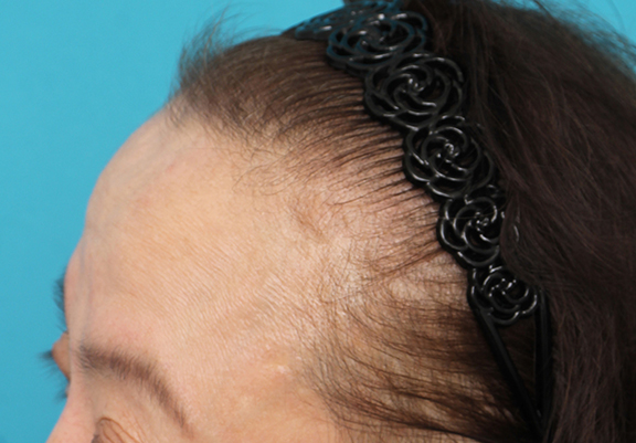 女性の薄毛治療,女性の薄毛治療の症例写真,Before,ba_aga_josei005_b04.jpg