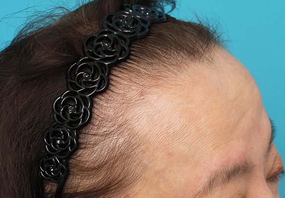 AGA治療（高須式メディカル育毛プログラム）,女性の薄毛治療の症例写真,Before,ba_aga_josei005_b05.jpg