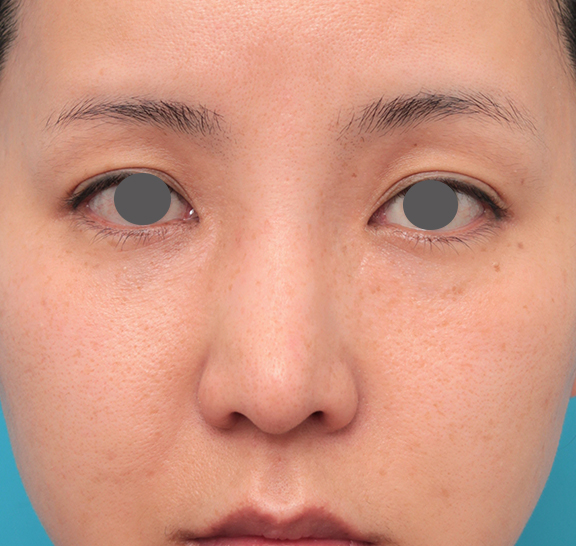 鼻先に耳介軟骨移植を行った30代女性の症例写真,After（6ヶ月後）,ba_jikai046_a01.jpg