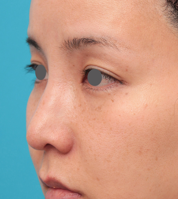 症例写真,鼻先に耳介軟骨移植を行った30代女性の症例写真,After（6ヶ月後）,ba_jikai046_b02.jpg