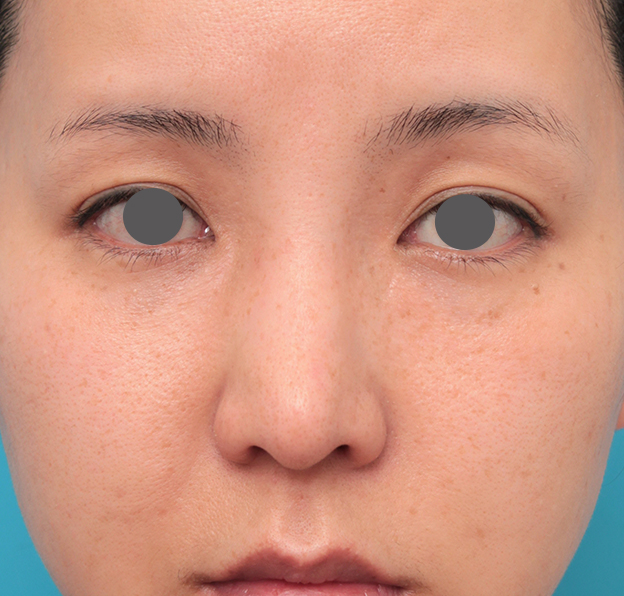 症例写真,鼻先に耳介軟骨移植を行った30代女性の症例写真,6ヶ月後,mainpic_jikai046d.jpg