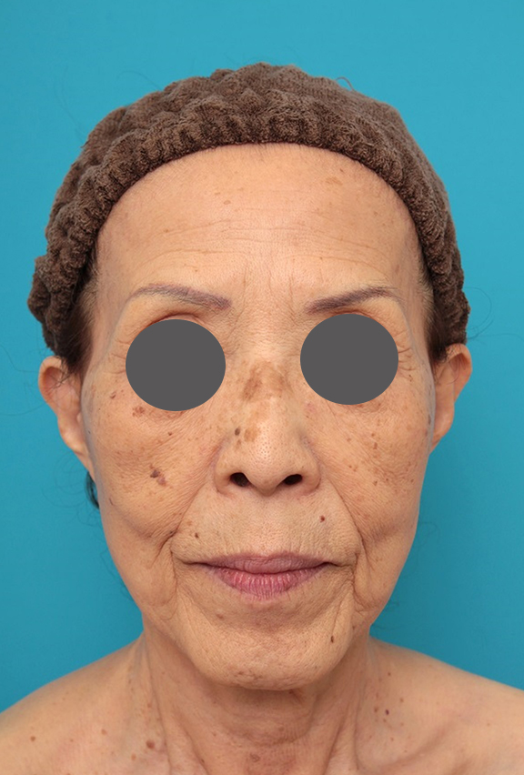 ミニフェイスリフト（頬のたるみ取り）,ミニフェイスリフトの症例 お顔全体のタルミとシワをリフトアップしたい70代後半女性,After（3ヶ月後）,ba_minilift011_a01.jpg