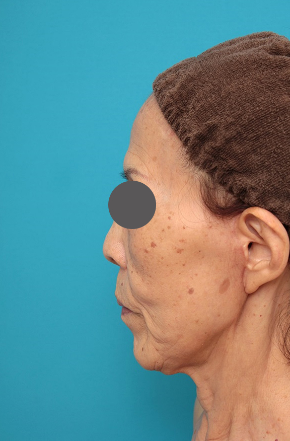 ミニフェイスリフト（頬のたるみ取り）,ミニフェイスリフトの症例 お顔全体のタルミとシワをリフトアップしたい70代後半女性,After（3ヶ月後）,ba_minilift011_b02.jpg