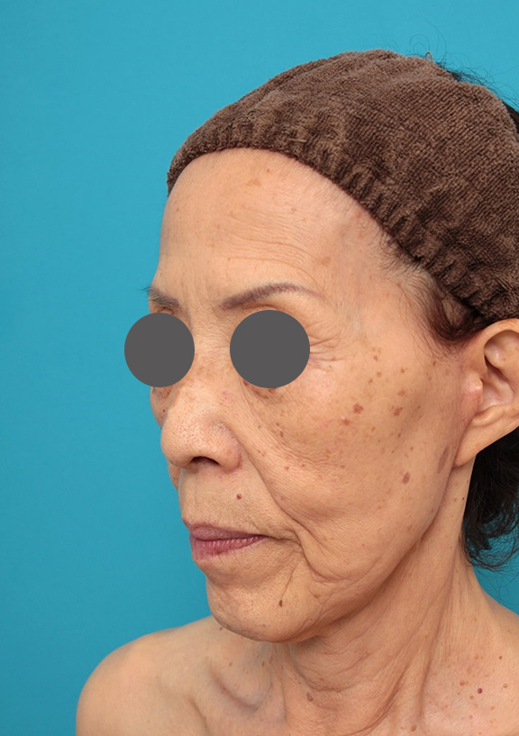 ミニフェイスリフト（頬のたるみ取り）,ミニフェイスリフトの症例 お顔全体のタルミとシワをリフトアップしたい70代後半女性,After（3ヶ月後）,ba_minilift011_b03.jpg