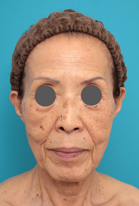 ミニフェイスリフト（頬のたるみ取り）,ミニフェイスリフトの症例 お顔全体のタルミとシワをリフトアップしたい70代後半女性,Before,ba_minilift011_b01.jpg