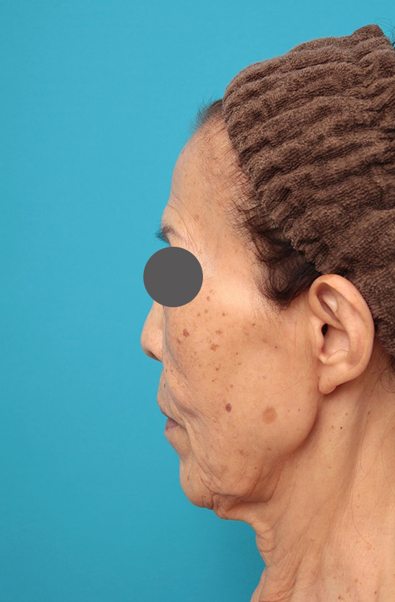 ミニフェイスリフト（頬のたるみ取り）,ミニフェイスリフトの症例 お顔全体のタルミとシワをリフトアップしたい70代後半女性,Before,ba_minilift011_b02.jpg