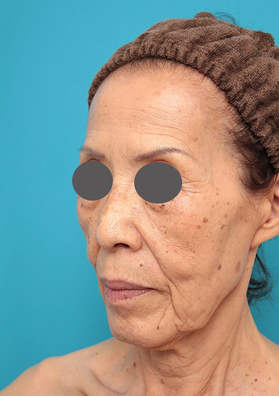 ミニフェイスリフト（頬のたるみ取り）,ミニフェイスリフトの症例 お顔全体のタルミとシワをリフトアップしたい70代後半女性,Before,ba_minilift011_b03.jpg
