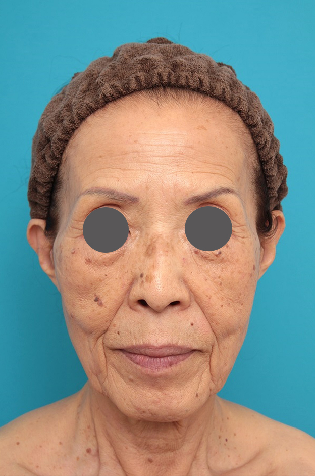 ミニフェイスリフト（頬のたるみ取り）,ミニフェイスリフトの症例 お顔全体のタルミとシワをリフトアップしたい70代後半女性,施術前,mainpic_minilift011a.jpg