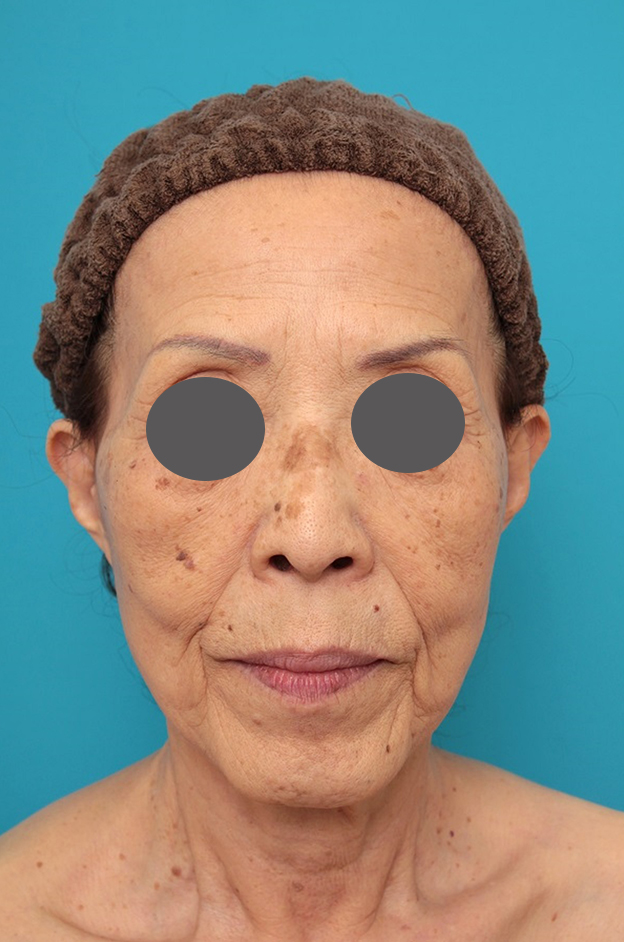 ミニフェイスリフト（頬のたるみ取り）,ミニフェイスリフトの症例 お顔全体のタルミとシワをリフトアップしたい70代後半女性,3ヶ月後,mainpic_minilift011c.jpg