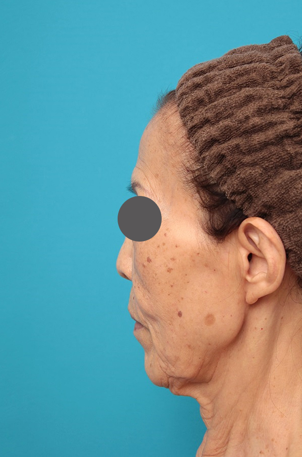 ミニフェイスリフト（頬のたるみ取り）,ミニフェイスリフトの症例 お顔全体のタルミとシワをリフトアップしたい70代後半女性,施術前,mainpic_minilift011d.jpg