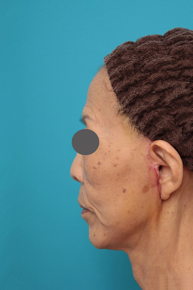 ミニフェイスリフト（頬のたるみ取り）,ミニフェイスリフトの症例 お顔全体のタルミとシワをリフトアップしたい70代後半女性,1週間後（抜糸時）,mainpic_minilift011e.jpg