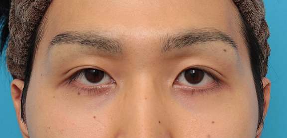 眼瞼下垂の症例写真,After（3ヶ月後）,ba_ganken043_a01.jpg
