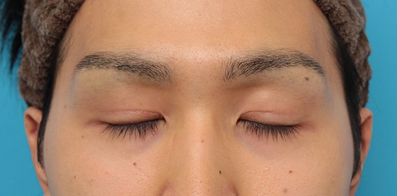眼瞼下垂（がんけんかすい）,眼瞼下垂の症例写真,After（3ヶ月後の目を閉じた状態）,ba_ganken043_b02.jpg
