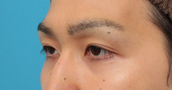 眼瞼下垂（がんけんかすい）,眼瞼下垂の症例写真,After（3ヶ月後）,ba_ganken043_b03.jpg