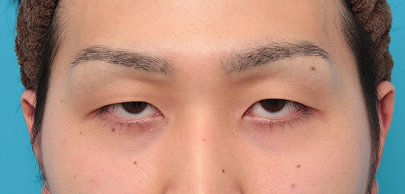 眼瞼下垂（がんけんかすい）,眼瞼下垂の症例写真,Before,ba_ganken043_b01.jpg