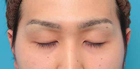 眼瞼下垂（がんけんかすい）,眼瞼下垂の症例写真,Before,ba_ganken043_b02.jpg