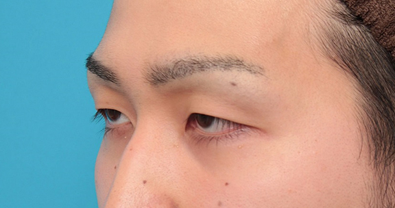 眼瞼下垂（がんけんかすい）,眼瞼下垂の症例写真,Before,ba_ganken043_b03.jpg