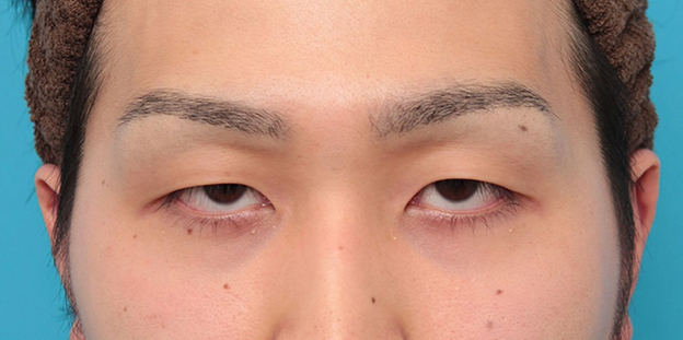 眼瞼下垂（がんけんかすい）,眼瞼下垂の症例写真,施術前,目を開けた状態,mainpic_ganken043a.jpg