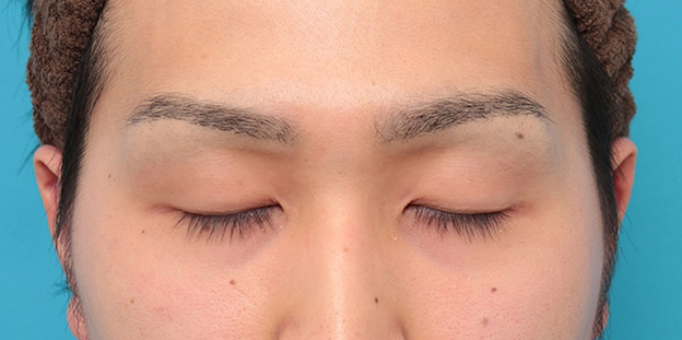 眼瞼下垂（がんけんかすい）,眼瞼下垂の症例写真,施術前,目を閉じた状態,mainpic_ganken043b.jpg