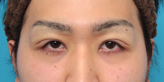 眼瞼下垂（がんけんかすい）,眼瞼下垂の症例写真,施術直後,目を開けた状態,mainpic_ganken043c.jpg