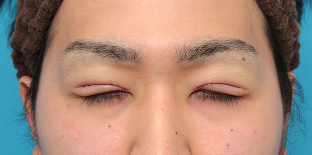 眼瞼下垂（がんけんかすい）,眼瞼下垂の症例写真,施術直後,目を閉じた状態,mainpic_ganken043d.jpg
